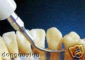 To remove supragingival heavy calculus.